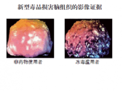 冰毒对脑组织损害严重